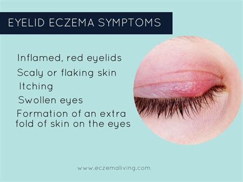 how long does eyelid dermatitis last sore eyelid causes when to see a doctor and treatment