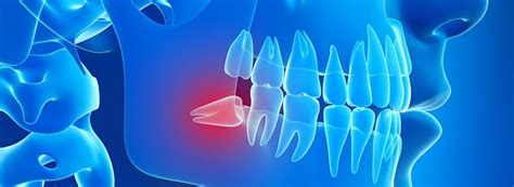 Wisdom Tooth Extraction What You Need To Know Milani Dentistry