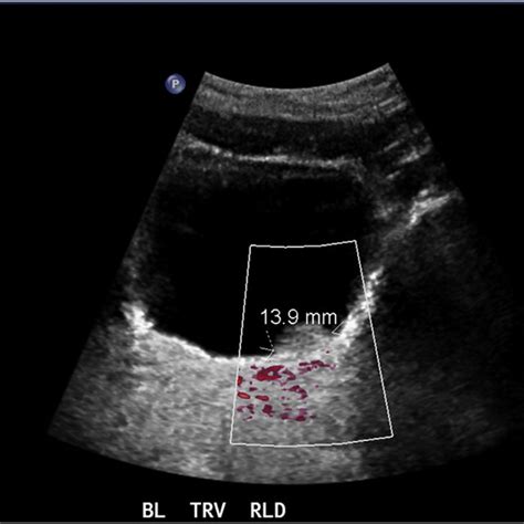 Ultrasound Image Of Lesion Within Urinary Bladder Download