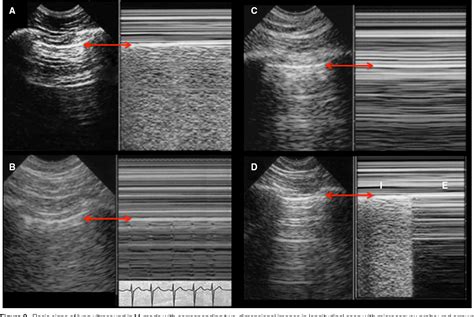 Lung Ultrasound For Critically Ill Patients Semantic Scholar