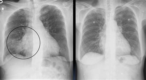 Chest X Ray Left Lower Lobe Pneumonia Ovulation Symptoms