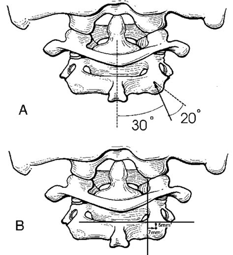 Surgical Anatomy Of The C2 Pedicle