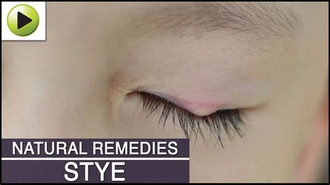 Stye Natural Ayurvedic Home Remedies Natural Skin Care Remedies