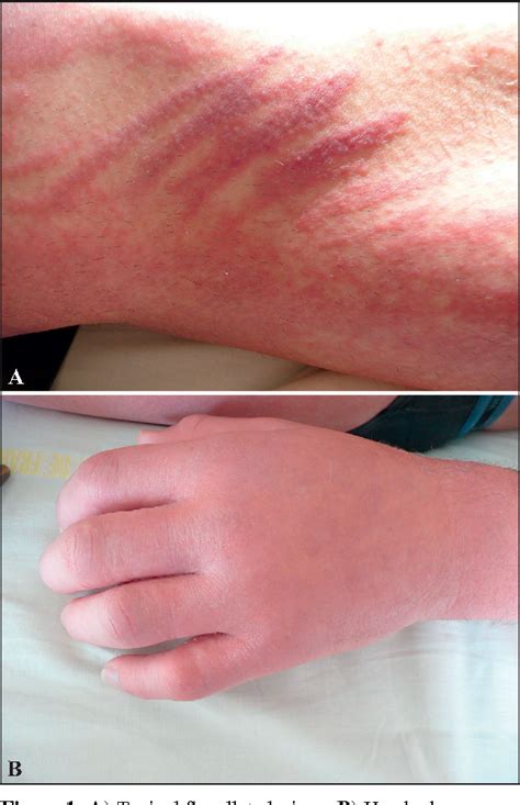 Figure 1 From The Diagnostic Usefulness Of Dermoscopy For Nevus