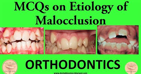 Dentosphere World Of Dentistry Mcqs On Etiology Of Malocclusion