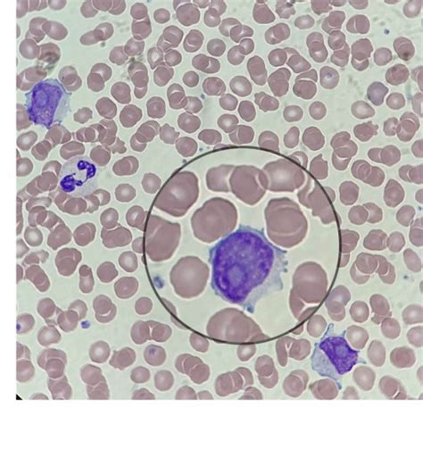 The type of leukemia depends on the type of blood cell that becomes cancer and whether it grows quickly or slowly. Leucemia Prolinfocítica B