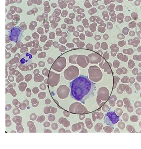 La leucemia mielógena crónica (lmc) es la más frecuente en los adolescentes. Leucemia Prolinfocítica B