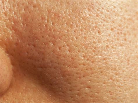 How To Get Rid Of Large Pores The Top 8 Ways
