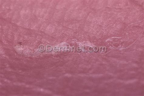 Scabies Photo Skin Disease Pictures
