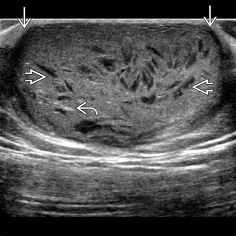 Epidermoid Cyst