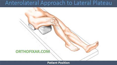 Anterolateral Approach To Lateral Plateau 2023 Orthofixar