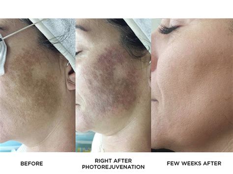 Photorejuvenation Photofacial Acne Rosacea And Melasma Treatment