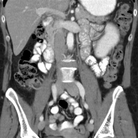 Congenital Hypoplastic Kidney Radiology Case