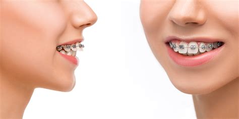 Dental Solutions For Overbite Underbite Crooked And Crowded Teeth