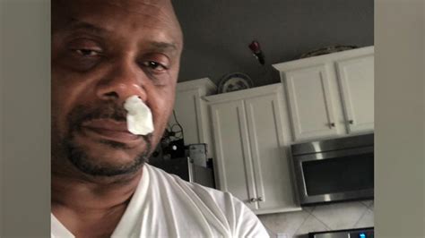 North Carolina Man S Runny Nose Turns Out To Be Leaking Brain Fluid Abc7 New York