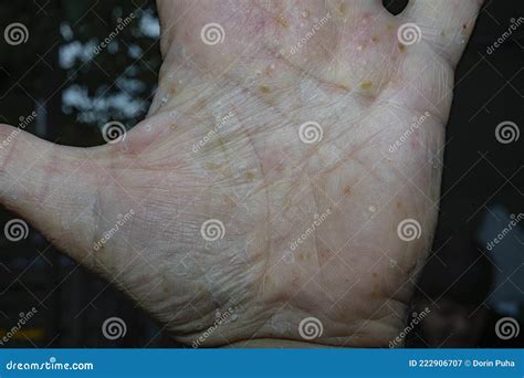 Pustular Psoriasis Lesions On The Left Palm Palmoplantar Psoriasis