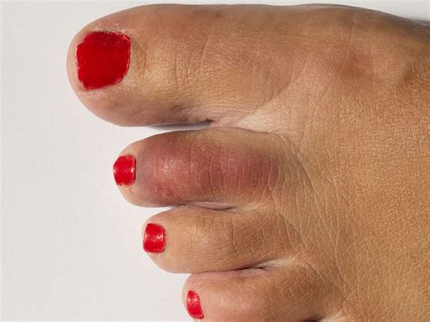 Broken Toe Symptoms Pictures And Treatment