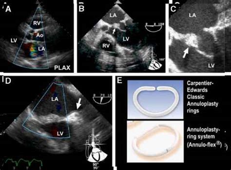 Annuloplasty Ring Echocardiogram Tricuspid Echocardiography