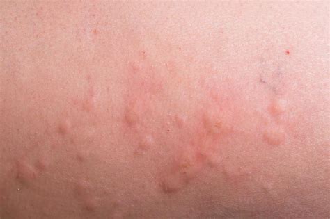 What Are The Treatments For Hives With Pictures