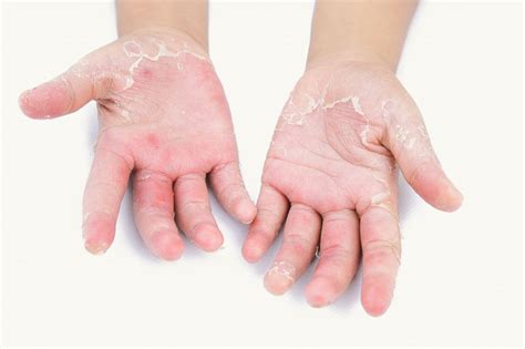 Itchy Rash On Palms Of Hands Treatment