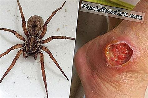 Führt Brown Recluse Spider Bites Wirklich Zu Amputationen 2023