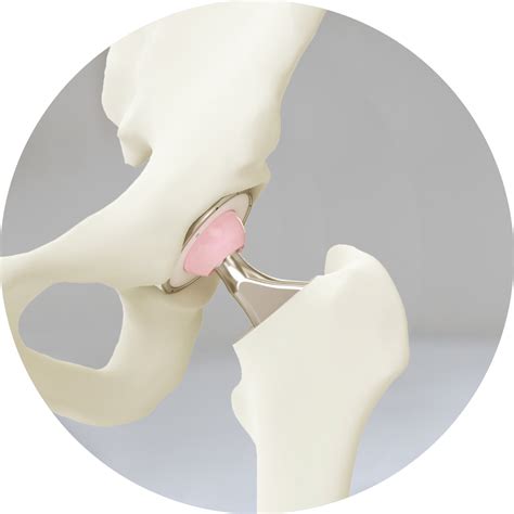 hip replacement surgery central coast dr simon hutabarat