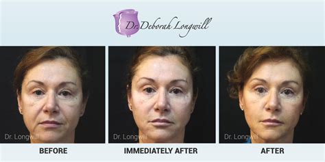 Miami Center For Cosmetic Dermatology Dr Deborah Longwill Belotero