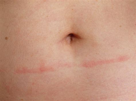 Causes Of Rash On Stomach Images