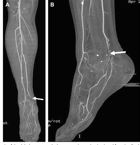 Figure From Ct Angiography Of The Lower Extremities Semantic Scholar