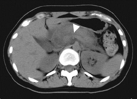 Ct Image From A Previous Hospital Shows Diffusely Swollen Pancreas And