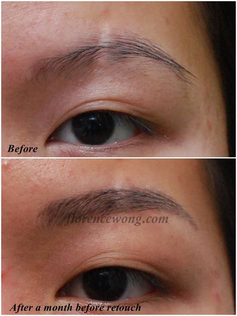 Elegant 3d Brow Embroidery~concealed Scar Brow After Peel Off Result