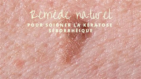 Remède Naturel Pour Soigner La Kératose Séborrhéique Youtube