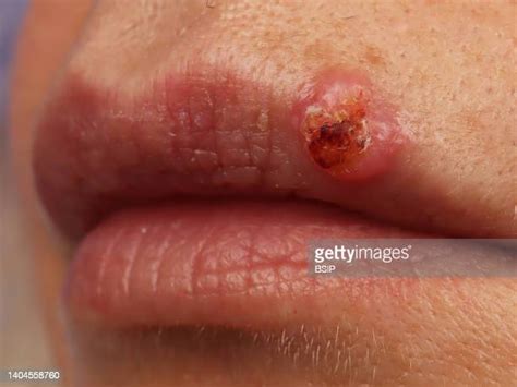 Squamous Cell Cancer Photos And Premium High Res Pictures Getty Images