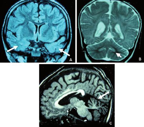 Brain Mri Findings For Patients With Cdkl5 Mutations Abnormalities