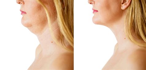 Lose Your Double Chin Kybella Farrell Plastic Surgery