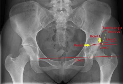 Tönnis Angle On An Anteroposterior Pelvic Radiograph In A Left Hip