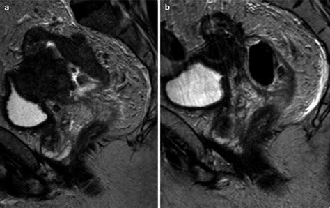 Fig 42 T2 Weighted Mri Of A Locally Diseases Of The Abdomen