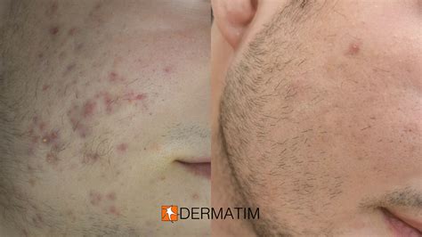 Acne Treatment For Scars Acne Scars Treatment Laser For Acne Scars