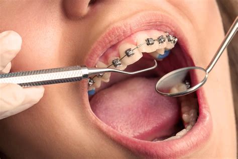 What To Consider In The Process Of Orthodontic Treatment