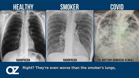 healthy lungs vs smokers lungs x ray