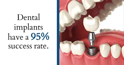 What Is The Success Rate Of Dental Implants