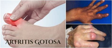 Artritis Gotosa Progresión Síntomas Causas Factores de Riesgo Diagnóstico y Tratamiento