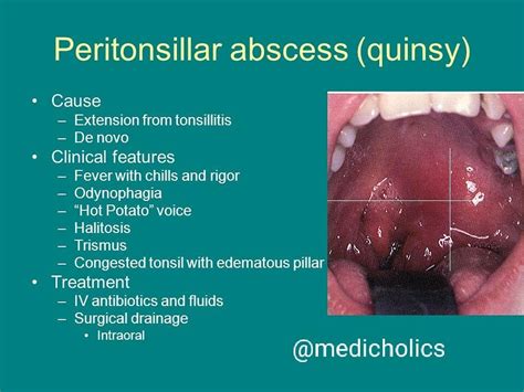 Peritonsillar Abscess Picture