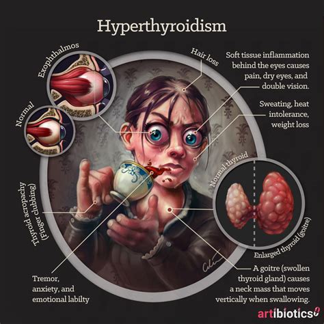 Spot Diagnosis Hyperthyroidism — Artibiotics