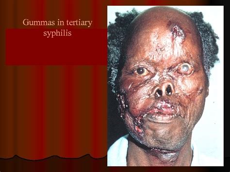 Tertiary syphilis is defined as symptomatic late latent syphilis, gumma and cardiovascular syphilis, but not neurosyphilis. Tertiary and congenital syphilis Principles of therapy and