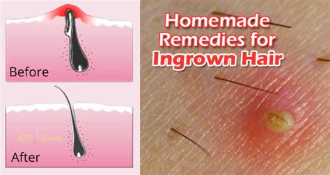 How To Get Rid Of Ingrown Hair