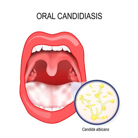 Oral Thrush Causes Symptoms And Remedies Gentle Dental