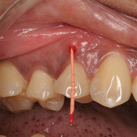 Depicting Deep Narrow Periodontal Probing On A Tooth With A Sinus Tract