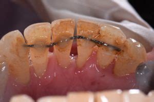 In recent years, clear dental aligners have become a popular way to straighten teeth without braces or how to straighten teeth: Stabilizing Mobile Teeth | Periodontal Splinting