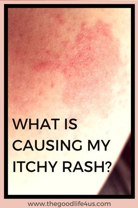 8 Best Types Of Rashes Ideas Types Of Rashes Rashes Rash On Face Images